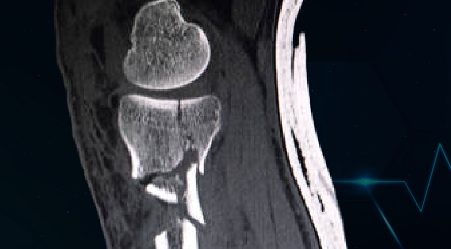 NaF Bone PET-CT Scan