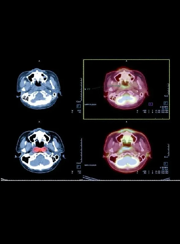 About DOPA PET CT Scan