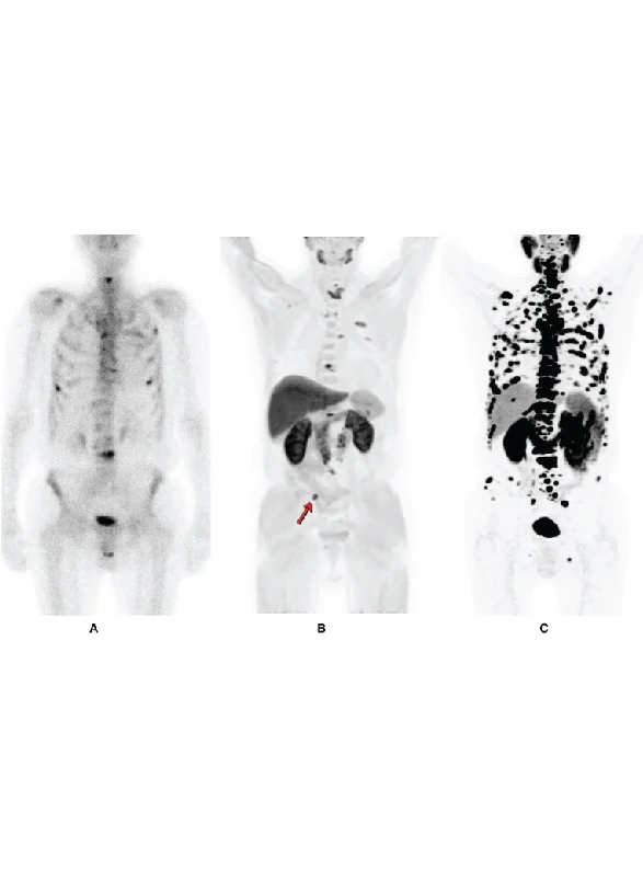 PSMA PET CT Scan