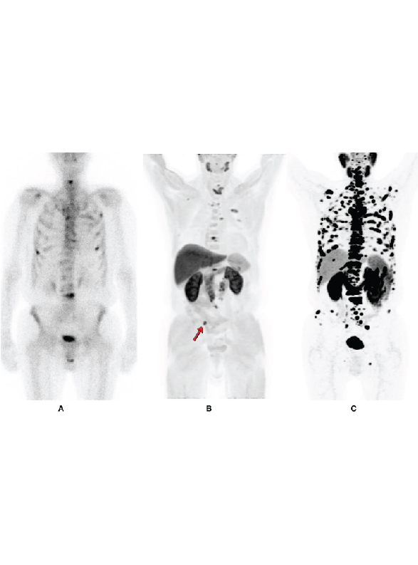 About PET-CT Scan